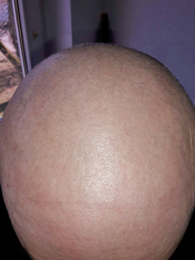 Gubitak kose od kemoterapije